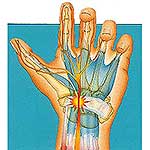 Carpal Tunnel Syndrome What is it? 
