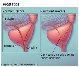Prostatitis Prostate Cushion